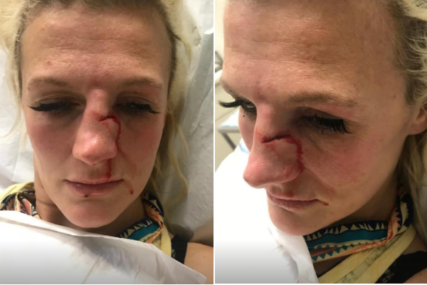 Ex-lutadora do UFC acusa ex-namorado de agredi-la por não aceitar separação