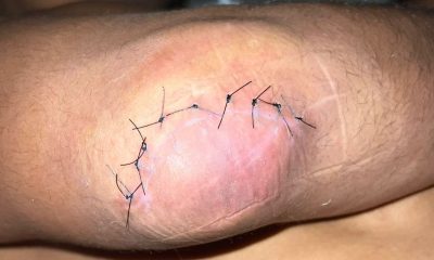 Borrachinha atualiza lesão sofrida no cotovelo