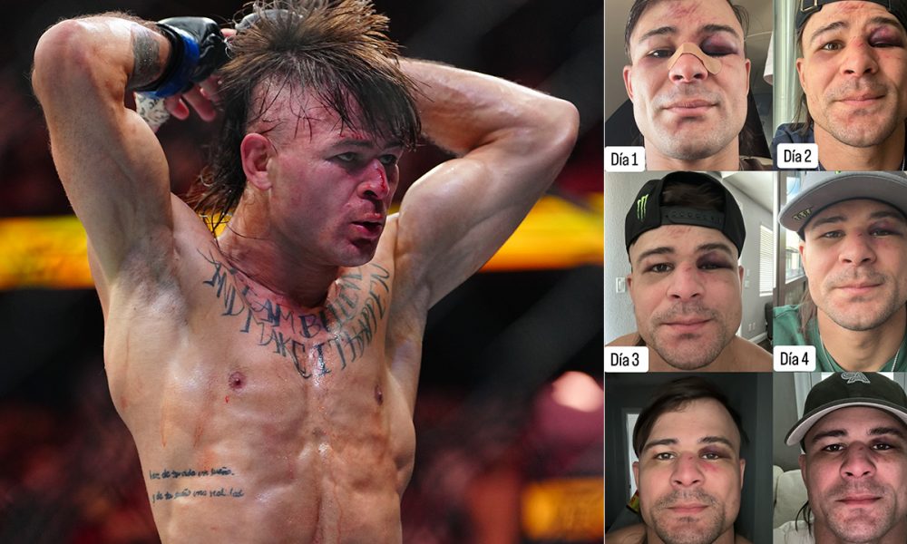 Diego Lopes postou uma foto com a evolução dos hematomas em seu rosto desde a luta com Alexander Volkanovski